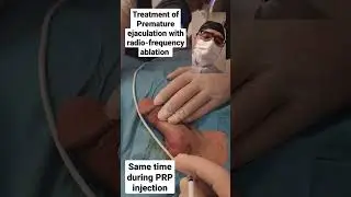 Treatment of Premature ejaculation with radio-frequency ablation. 