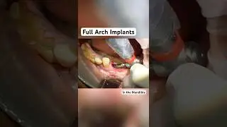 Full arch for the mandible by Dr Madrigal #aox #dentalimplants #dentalstudent #oralsurgery