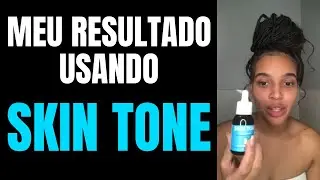 SKIN TONE CLAREADOR Minha Experiência com Melasma!