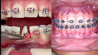 Dental Braces,Compilation videos