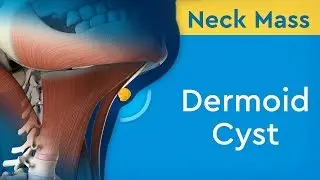 Neck Mass: Dermoid Cyst