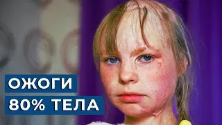 🔥 Моя дочь ЧУТЬ НЕ СГОРЕЛА заживо / Ожог 80% тела, Алеся 9 лет