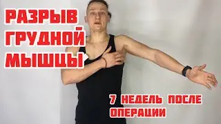 Разрыв грудной мышцы, отрыв грудного сухожилья. Личный опыт: седьмая неделя после операции.