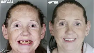 Dream Smile Transformation All on 4 Dental Implants