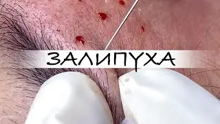 ПРЫЩИ 😍 ПРЫЩИ ВЫДАВЛИВАНИЕ 😍 ПОДБОРКА ВЫДАВЛИВАНИЕ ПРЫЩЕЙ 