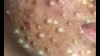 Удаление черных точек 2021 - Remoção de cravo 2021 - Pimple Popping 2021 Blackhead Removal