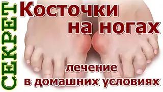 Косточки на ногах лечение