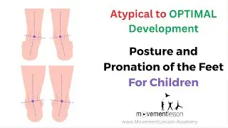 Atypical Development Baby Posture and Pronation of the Feet