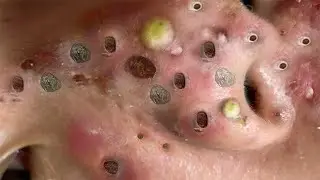 pimple popping - blackhead removal - blackheads removal - acne treatment - skin care - 1920