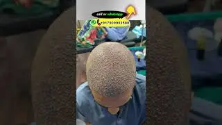 UNBELIEVABLE HAIR TRANSPLANT RESULT IN INDIA ||