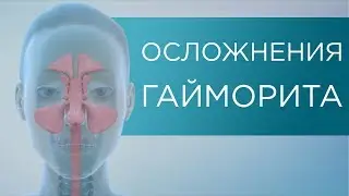 ОСЛОЖНЕНИЯ ГАЙМОРИТА