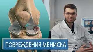 ТРАВМА МЕНИСКА | Боль и хруст в колене