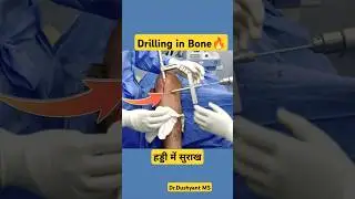Drill Hole in Bone हड्डी में सुराख 🔥