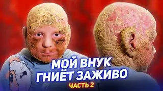 Мой внук ГНИËТ ЗАЖИВО / ЧЕШУЯ вместо кожи / Синдром KID, Ихтиоз / Часть 2 [Добрый Волшебник]