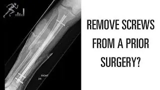 When can you remove screws from a prior surgery?