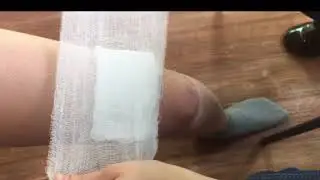 Оказание первой помощи при термических ожогах