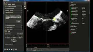 Mitral Valve Analysis: Philips MV Navigator