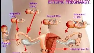 Ectopic Pregnancy