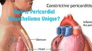 pericardial mesothelioma
