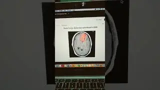 Brain Tumour Detection