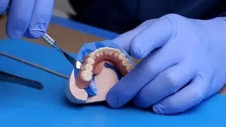 The Pickup (Remove the Denture) - Smart Denture Conversions Training