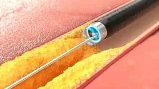 Peripheral Artery Disease Catheter - Infuse Medical