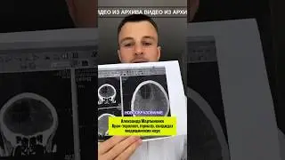 Опухоль мозга #docalexlife #доктор #ракмозга #опухоль #рак #советыврача #онкология