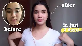 GOODBYE PIMPLES IN JUST 7 DAYS!!!