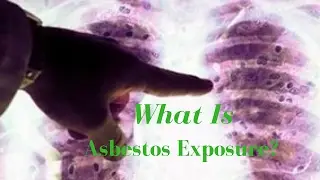 Asbestos poisoning