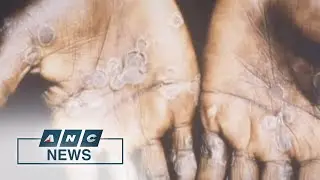 Europe eyes smallpox vaccine for monkeypox | ANC