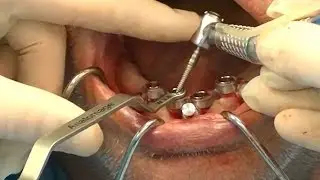 Zest LODI Guided Surgery - Mandibular Implants