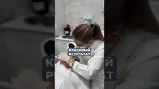 Плюсы удаления сосудов на аппарате Lumecca 