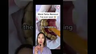 Heavy Tartar Removal 