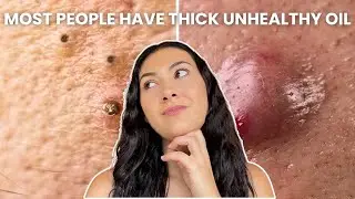 How To Treat Every Type of Acne (Comedones, Nodules, Cysts)