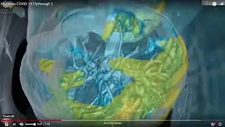 Врачи США показали видео, как коронавирус пожирает легкие человека