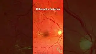 Retinopatia diabética proliferativa