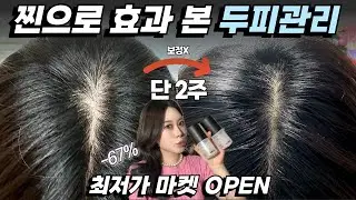 탈모 관리법🔥실제 2주 사용 후 사진🔥관리하면 무조건 됨😎지금이라도 시작