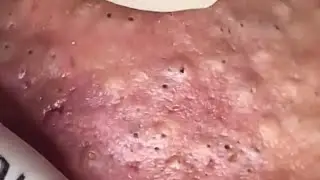 Blackheads & Whiteheads Satisfying Removal @0275