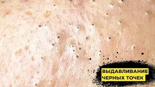 ЧЕРНЫЕ ТОЧКИ🔥 ВЫДАВЛИВАНИЕ. УХОД ЗА ЛИЦОМ