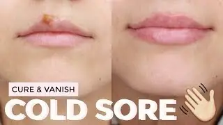 HOW TO : Cure a cold sore FAST | Healed & Scab Free