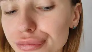 вопрос косметологам🙏последствия филлеров 😓