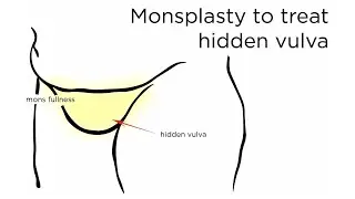 Monsplasty: FUPA Correction | how to treat excessive mons | Newport Beach Plastic Surgeon explains