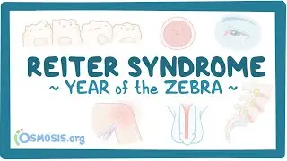 Reiter syndrome (Year of the Zebra)