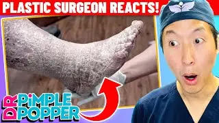 Plastic Surgeon Reacts to DR. PIMPLE POPPER: Feet of STONE?!?