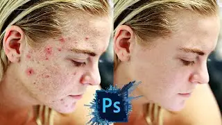 How to remove pimples in Photoshop 2022
