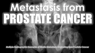 Metastasis from Prostate Cancer #prostate #cancer #xray