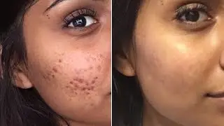 Find out what diseases indicate acne on the face
