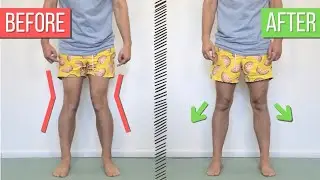 How to Fix Knock Knees (Valgus Knees)