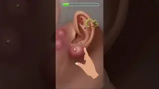 ASMR treatment of ear