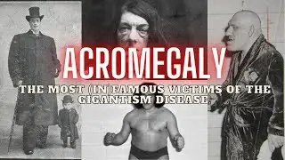 ACROMEGALY: The Most (In)Famous Victims Of The Gigantism Disease ( Full Pictures )